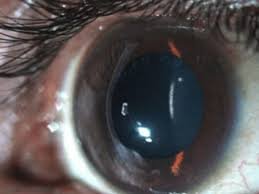 Keratoconus evaluation and management