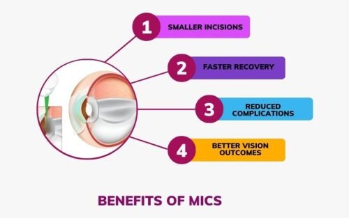 Benefits of MICS cataract surgery in bengaluru